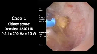 AUA2019 V01-01 Prospective Transurethral Lithotripsy Study with SuperPulse Tm Fiber Laser