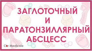 Заглоточный и паратонзиллярный абсцессы - что такое, причины, осложнения