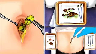 ASMR Giant Navel Stone Removal | Navel Cleaning & Treatment ASMR