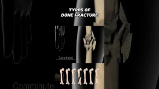 Common Types Of Bone Fracture 3D Animation #bonefracture