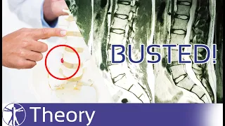 The Truth about Lumbar Disc Herniations | Myth Busting