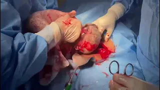 Breech baby delivery at cesarean section