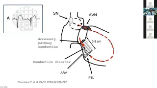 7 17 20 Moore Catheter Ablation in Adult Congenital Heart Disease pt 2