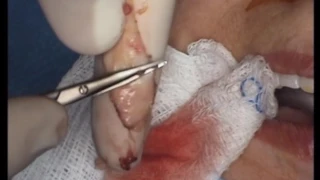 Harvesting of Mucous Membrane Graft (Buccal mucosa)