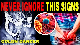 Critical Colon Cancer Symptoms You Should Never Ignore - Signs and Treatment