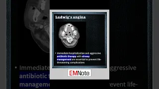 Ludwig's Angina  #medical #doctor #nursing