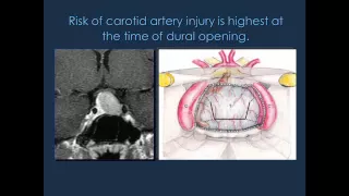 Updated Video Available: Doppler Probe Helps Prevent Carotid Injury in Endoscopic Pituitary Surgery