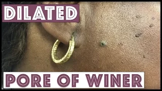 Two small Dilated Pore of Winers on the face