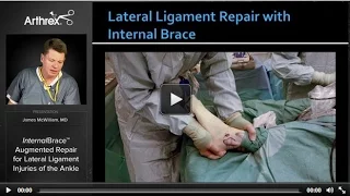 InternalBrace™ Augmented Repair for Lateral Injuries of the Ankle