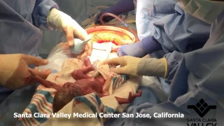 Santa Clara Vally Medical Center - Delayed Cord Clamping