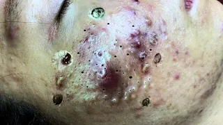 cystic acne blackhead whitehead removal | Relaxing Spa Acne Treatment