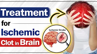 Treatment for Ischemic Clot in Brain | Ischemic Stroke in Paralysis | SRIAAS