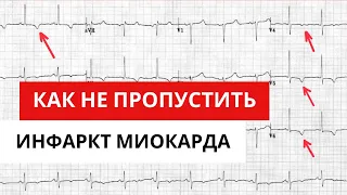 Как не пропустить инфаркт миокарда. Сложности анализа ЭКГ.