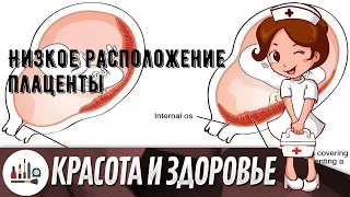 Низкое расположение плаценты