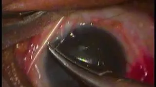 PED With Corneal Opacity