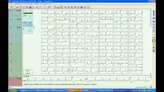 TLC9803 3 leads 3 Channels  ECG Holter Operation English