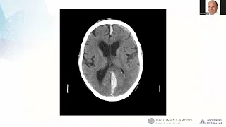 CNS Neurosurgery 100: Acute Subdural Hematoma