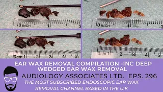 EAR WAX REMOVAL COMPILATION - INC DEEP WEDGED EAR WAX REMOVAL - EP 296