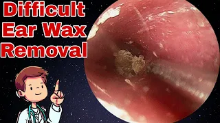 Difficult Ear Wax Removal Close To The Eardrum | Doctor Anh