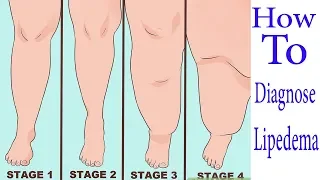 Diagnose Lipedema, how to diagnose Lipedema