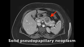 Robotic spleen sparing distal pancreatectomy | Narrated video illustration