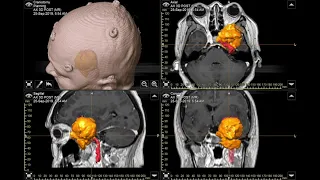 Surgery: Modified Orbitozygomatic (OZ) Craniotomy for meningioma