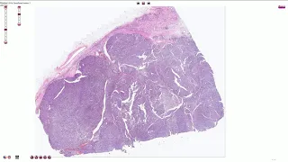 Papillary Renal Cell Carcinoma - Histopathology