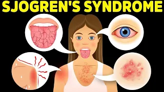 The Best Protocol for Sjogren's Syndrome