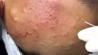 SUPER Removal of Cyst, Acne on the Forehead at HIỀN VÂN SPA  - Part 3 # TRỊ MỤN HIỆU