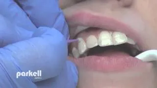 Desensitizing tooth surfaces using Brush&Bond or Pain-Free F.