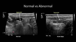 US for Suspected Appendicitis in Children