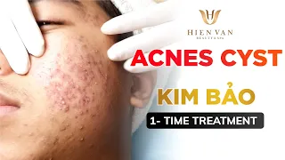 Điều Trị Mụn Hiệu Quả, Uy Tín Nhất TPHCM Tại Hiền Vân Spa I Kim Bảo I bai 398