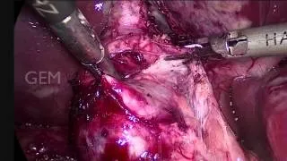 Laparoscopic Type I Choledochal Cyst Excision and Hepaticoduodenostomy in a 4 Year Old Child