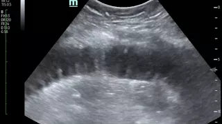 Bedside Ultrasound for the Diagnosis of Small Bowel Obstruction  JETem 2017