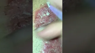 Psoriasis Scab Peel #2