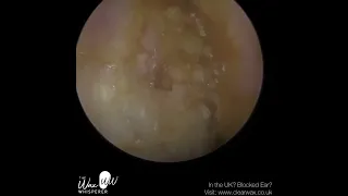 1,096   Complex Swollen & Infected Ear Wax Removal​ 028