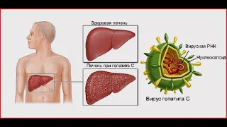 Современная противовирусная терапия гепатита C