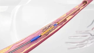 3D Medical Animation: Vascular Stent System for Leg Arteries