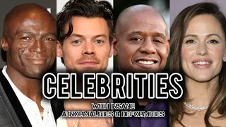 Celebrities With Abnormalities & Deformities