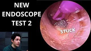 Musket Ball Ear Wax Extracted With New Endoscope
