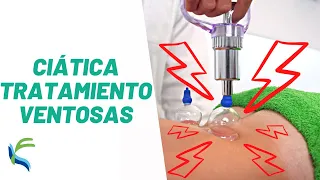 CIATICA tratamiento con VENTOSAS | Fisiolution