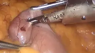 Laparoscopic Mini Gastric Bypass