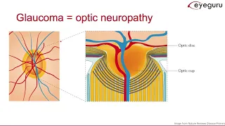 4.2: Primary Open Angle Glaucoma (clinical manifestations, diagnosis)