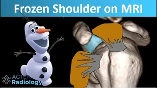 How Frozen shoulder looks on MRI