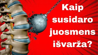 Kaip susidaro juosmens išvarža? Juosmens išvaržos gydymas. 2 specialūs kineziterapijos pratimai