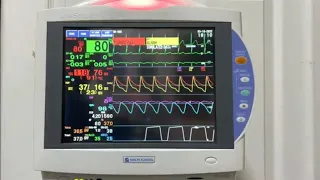 心電図モニター 実際の測定　Demo-Alarm (デモアラーム) [NIHONKOHDEN LifeScope TS]