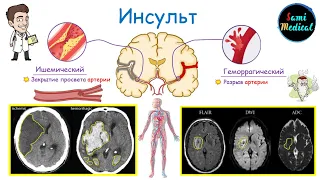 Инсульт Головного Мозга | Виды | Анатомия | Физиология | Патогенез | Клиника | Диагностика | Лечение
