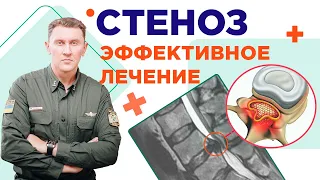 Как правильно лечить стеноз! Нейрохирург Александр Печиборщ