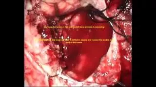 MENINGIOMA BRAIN-large occipetal falx-microsurgery-dr suresh dugani/HUBLI/KARNATAK/INDIA