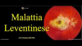 Malattia Leventinese. Distrofia Retiniana en Panal de Doyne. Drusas Radiales Autosómicas Dominantes.